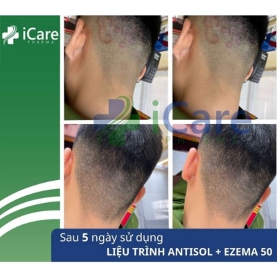 Combo Dầu Gội Trị Gàu Antisol + 1 Kem Ủ Enzema50 8 combo-dau-goi-antisol-kem-u-enzema50