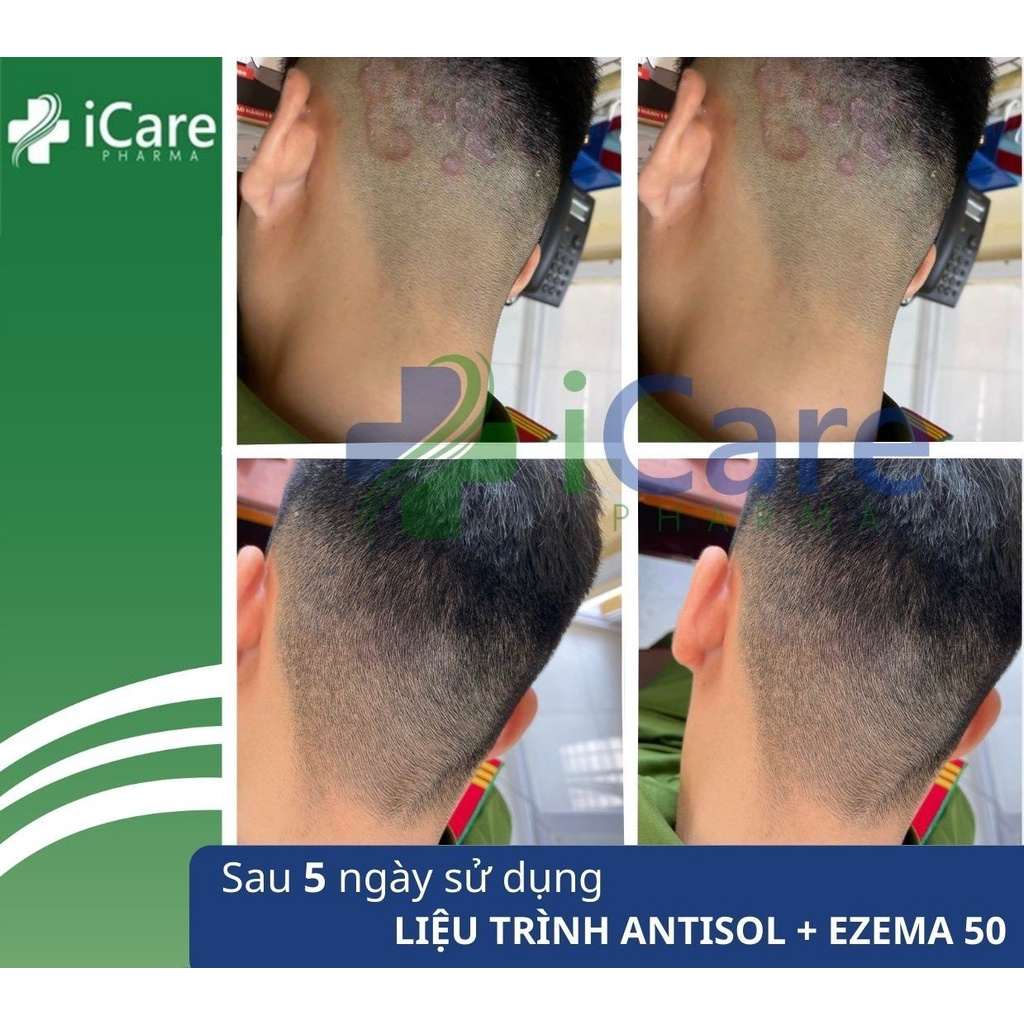 Combo Dầu Gội Trị Gàu Antisol + 1 Kem Ủ Enzema50 2 combo-dau-goi-antisol-kem-u-enzema50