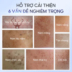 kem-duong-da-fresh-lady-ho-tro-mo-tham-giam-nam