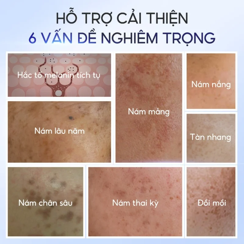 kem-duong-da-fresh-lady-ho-tro-mo-tham-giam-nam