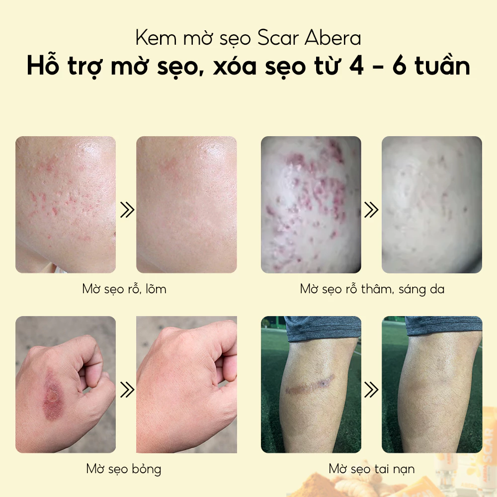 Kem Sẹo Nghệ Đỏ Abera Scar - Hỗ Trợ Làm Mờ Sẹo, Giảm Sẹo Lõm, Sẹo Rỗ, Sẹo Lồi, Sẹo Thâm 5 kem-seo-nghe-do-abera-scar