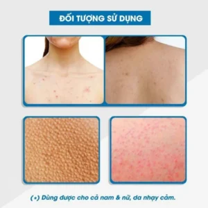 xit-mun-lung-gel-tam-ngua-mun-novocare-freeskin-forte