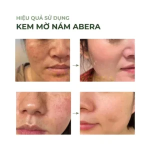 kem-nam-da-abera-lam-mo-tham-nam-tan-nhang