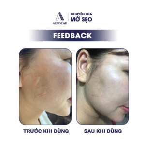 combo-kem-va-serum-ho-tro-mo-seo-loi-seo-phi-dai-actiscar