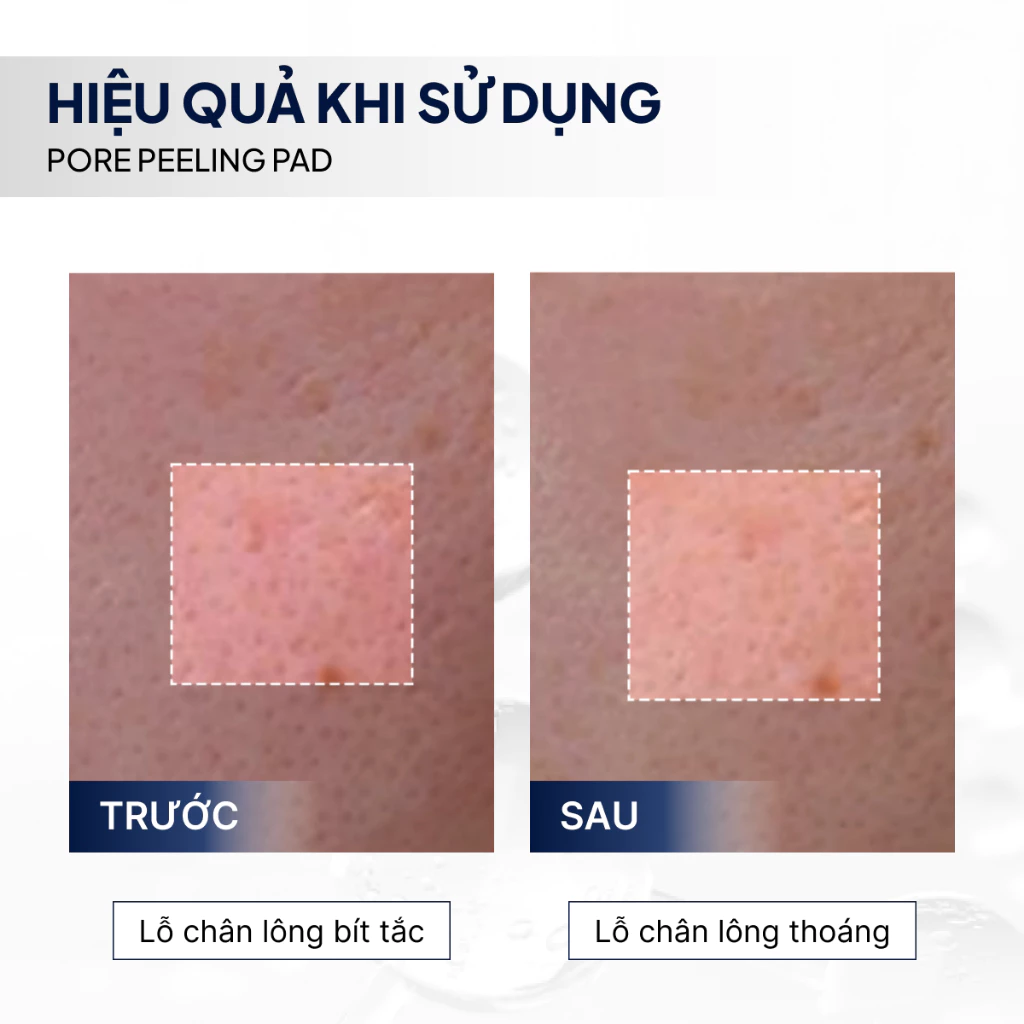 Tẩy da chết BHA Pore Peeling Pad LUBYLAB 6 tay-da-chet-bha-pore-peeling-pad-lubylab